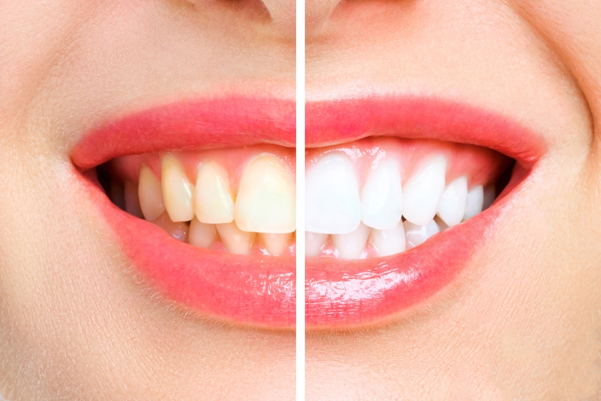 Teeth Whitening in Richmond