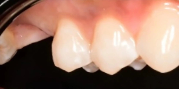 Dental Bridges in Richmond