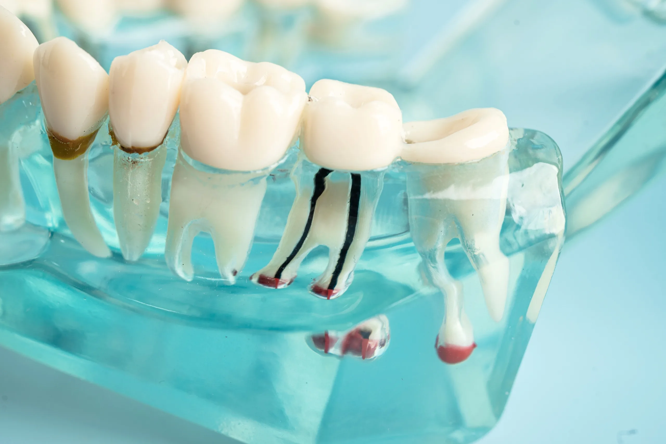 Do You Need a Root Canal Before a Crown